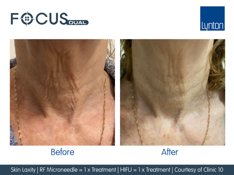 Skin Laxity on Neck - Before and After 1 Focus Dual HIFU and 1 RF Microneedling Treatments (1)