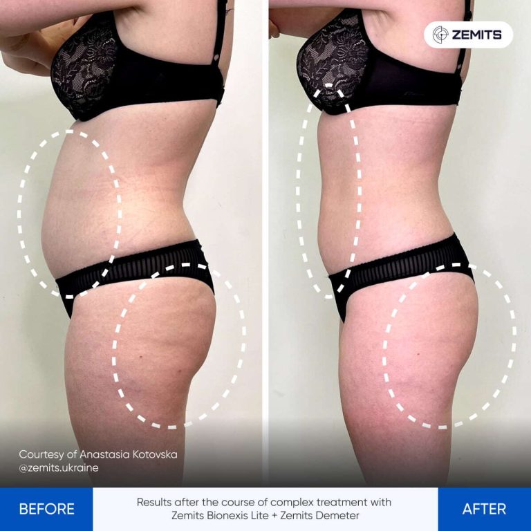 BeforeAfter_Demeter20_11_UK