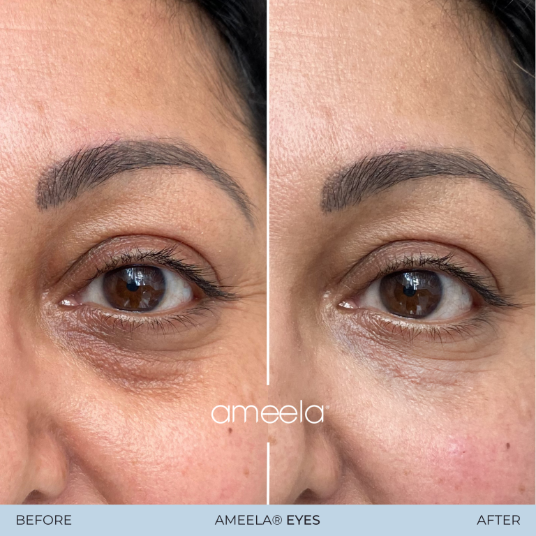 Copy of Copy of Ameela Eyes - Before_After 02