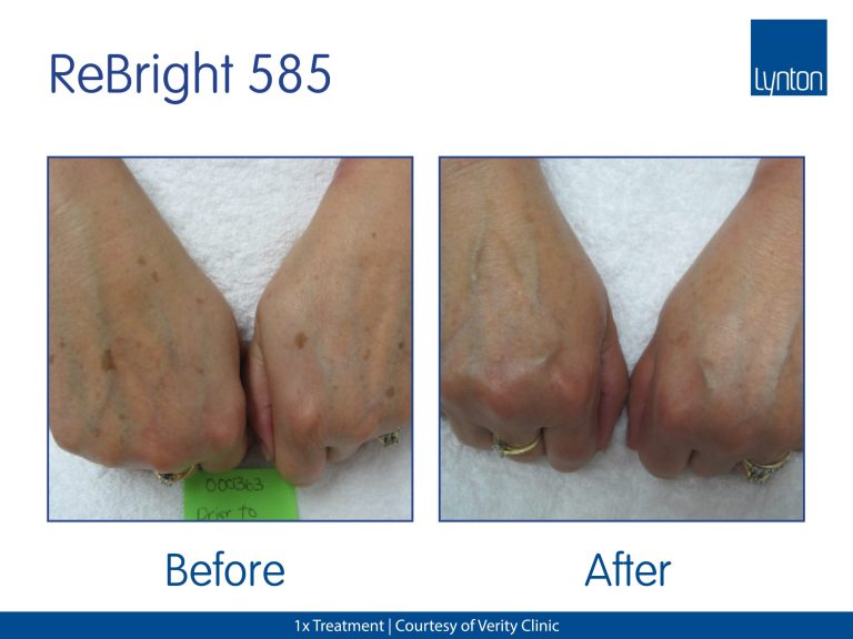 Pigmentation sun spots
