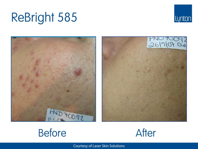 Acne-Laser-Skin