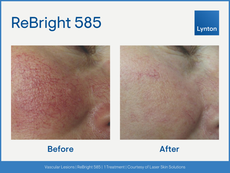 vascular-redness-rosacea