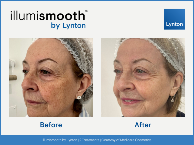 Pigmentation Facial